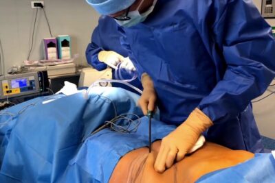 Surgeon performing abdominal liposuction and contouring on a draped patient in an operating room during chirurgie esthetique 1