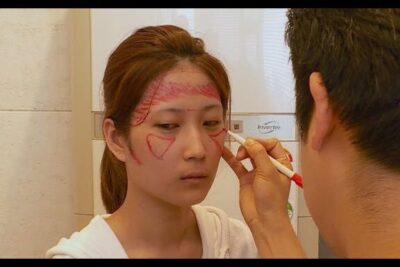 Patient with red preoperative facial markings during a cosmetic surgery consultation.