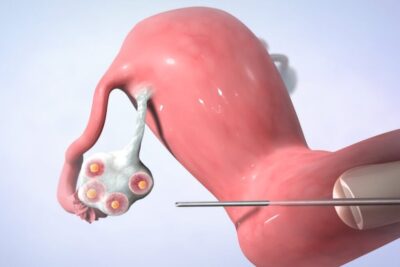 3D medical illustration of an ovary with multiple follicles and a retrieval needle for an in vitro 2 procedure.