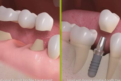 Close-up dental illustration showing a three-unit bridge on prepared abutments beside an implant with abutment and crown konventionell medicin 1.