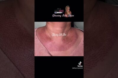 Close-up of neck with dotted healing pattern after kosmetiska ingrepp skin resurfacing treatment