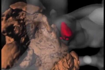 3D anatomical rendering of a liver region with a red-highlighted lesion illustrating lepatite b concept.