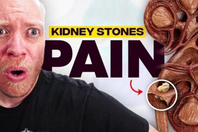 Shocked man reacting to kidney stones pain with anatomical kidney cross-section showing a stone, mellem konnene.