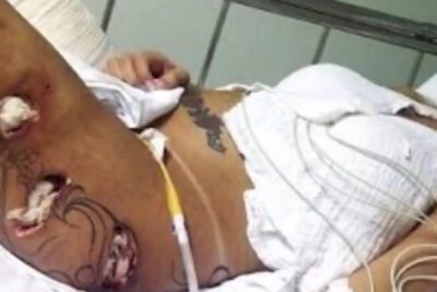 Close-up of a person's torso showing multiple post-surgical wounds packed with gauze, visible drainage tube and monitoring leads, operazioni estetiche 1.