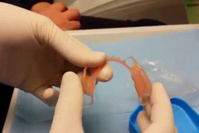 Gloved hands holding a gum-colored flexible partial denture protesi estetiche 1 over a blue dental tray.