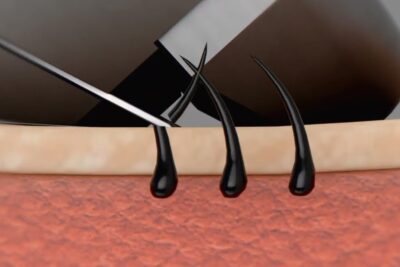 Razor blade trimming stubble at skin surface with visible shaving grain and hair follicles.